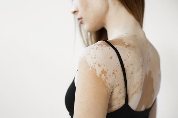 Aromaterapi İle Vitiligo Tedavisi